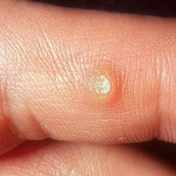 От чего появляются бородавки у человека?