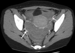 Свободная жидкость в малом тазу у женщин — это опасно? 