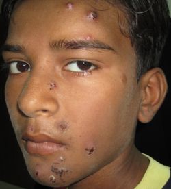 Стрептодермия: лечение и предостережения