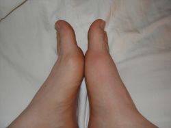 Лечение подагры народными средствами: несколько эффективных методов