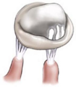 Опасность пролапса митрального клапана (ПМК) 1 степени