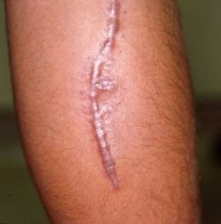 Келоидный рубец: причины появления, лечение