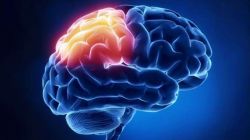 Что такое очаговое изменение вещества мозга дистрофического характера?
