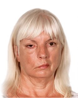 Паралич Белла: причины, лечение, диагностика