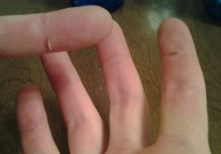 Из-за чегооблазит кожа на пальцах: возможные причины