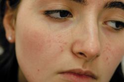 Угревая сыпь на лице: причины и лечение