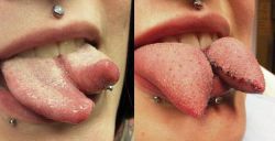 Как делают сплит языка? Каковы последствия? Отзывы о процедуре